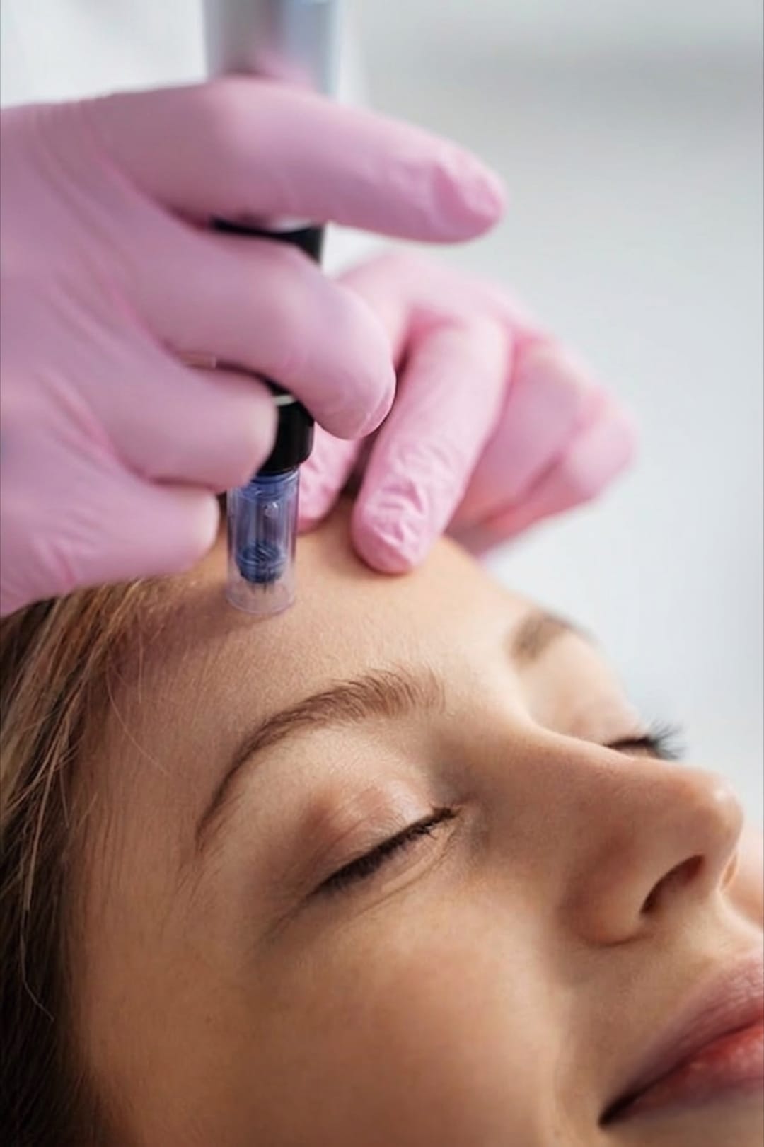 Microneedling-behandling nær arbeidet